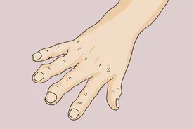 早起后手指肿胀、握不紧，怎么回事？积极排查4种问题，别忽视图片