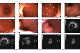 老人吃饭经常噎到，原来是食管长了8厘米巨大肿物！——哈医大一院专家运用内镜技术成功拆瘤图片