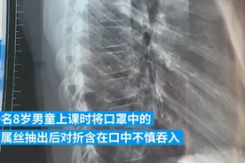 8岁男孩上课玩口罩误吞5厘米金属丝，医生：第一次遇到图片