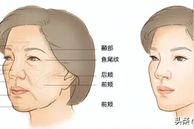 想要面部轮廓光滑，作为解决方案的自体脂肪填充有什么优缺点？图片