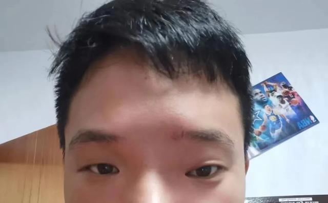 20岁男孩的4次手术：一次取出20多颗瘤，曾吓得嚎啕大哭