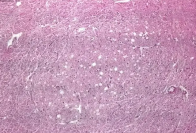 鐑圭叜閮芥潃涓嶆鐨勬湂鐥呮瘨锛岃嚧姝荤巼100%鏃犺嵂鍙晳锛佹劅鏌撳悗鏈夊鎭愭€栵紵