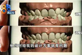 网购牙套矫正后 觉得设计方案“美化”了图片