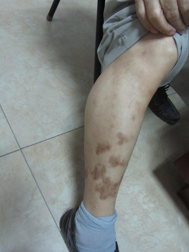 什么是变应性皮肤血管炎(变应性皮肤血管炎的病理特征是)-第2张图片