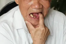 牙齿松了别着急拔！这样做或许还能恢复！图片