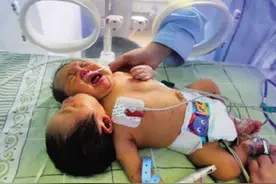 2011年，四川孕妇生下一对“双头女婴”，后想放弃抚养权再生一个图片