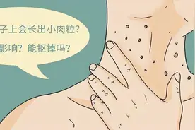 脖子和腋下的“小肉粒”是什么？能直接用手揪掉吗？看完要牢记图片