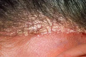 儿子理发后头上长红疙瘩，怀疑理发店卫生问题，毛巾未消毒染皮炎图片