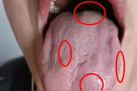 哪种舌像容易长息肉，结节，囊肿？看中医如何用一味中药攻破图片