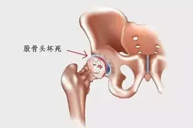 股骨头III期坏死能不能痊愈？需迈过这4道门槛，要不步入塌陷深渊图片