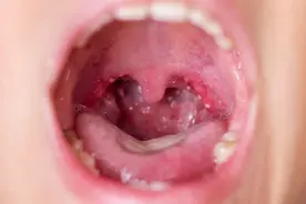 @家长们，疱疹性咽峡炎进入高峰期，如何防治看这里图片