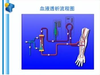 什么是血液透析？血透的工作原理是什么？