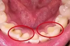 牙齿上有黑黑的东西怎么办？图片