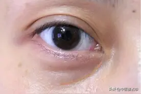 眼袋大，老10岁？也不是脾虚，不是肾虚，多是因为这个地方堵了！图片