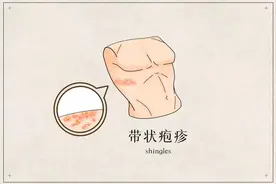 带状疱疹的症状与体征以及临床治疗方案简介图片