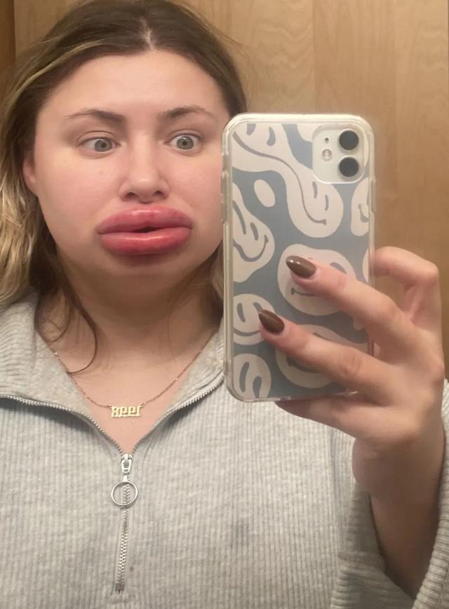 美国女子做丰唇手术,过敏肿胀8倍成"香肠嘴",差点危及生命