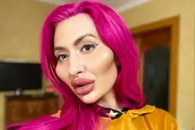这个动手术打造"世界最高颧骨"的女人，再次向自己的颧骨下手了图片