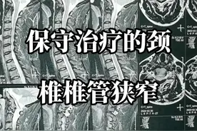 颈椎轻度椎管狭窄，漂流外伤引起手指刺痛，保守治疗好转明显，目前不必手术#科普知识 #颈椎椎管狭窄 #挥鞭伤 