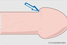 如何分辨珍珠疹和尖锐湿疣？主要看5点区别，看完就能轻松分辨图片