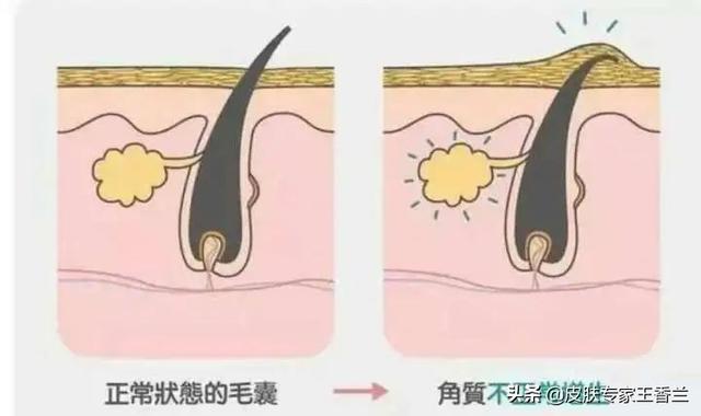 去医院皮肤病看鸡皮