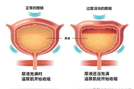 膀胱过度活动症是什么？有什么特点？该如何治疗？图片