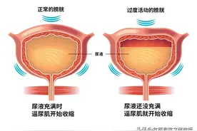 膀胱过度活动症是什么？有什么特点？该如何治疗？图片
