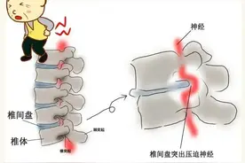 腰痛腿麻？腰椎间盘突出日常生活中需要注意的事项图片