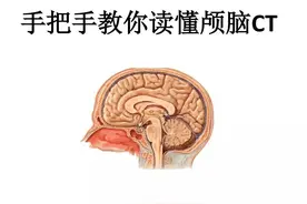 手把手教你读懂颅脑CT图片