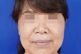 62岁不怕切口长做全脸拉皮手术，真人“全程实录”，第15天不P图图片