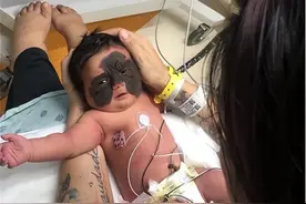 还记得天生胎记酷似“蝙蝠侠”的女婴吗？6次整容后，仍在治疗图片
