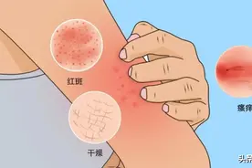 小杨课堂 | 浑身瘙痒是怎么回事？带你缉拿“真凶”→图片