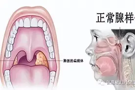 腺样体肥大必须切除吗？它可是一个有用的器官，不能轻易切除它图片