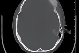 [骨与关节]骨纤维异常增殖症图片