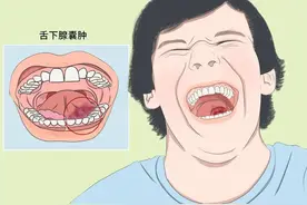 舌下长“水泡”，这是舌下腺囊肿图片