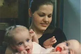 双胞胎女婴腹部相连医生都说活不了，4岁做分离手术如今已满20岁图片