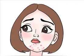 下巴长痘的原因有哪些？图片