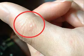 手上起小水泡，又痒又痒又脱皮怎么办，医生教你应对小妙招图片