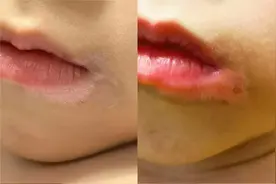 身体突然长白斑是什么原因？牢记单孔荣主任这三点明确分辨白癜风图片