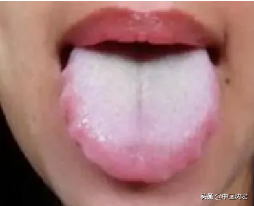 张仲景祛湿方，四味药，化痰祛湿，让你“无湿”一身轻