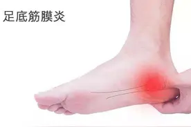 跑步时脚后跟疼，不要觉得忍忍就好，医生告诉你：或是得了这种病图片