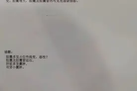 53岁的她胆囊息肉1.8cm，医生怀疑胆囊癌，开腹手术后却是良性的图片