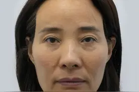 年龄增大，面部呈现“空”“松”“垮”怎么办？医生说出解决真相图片