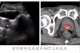 前列腺钙化是癌症的前兆吗？图片