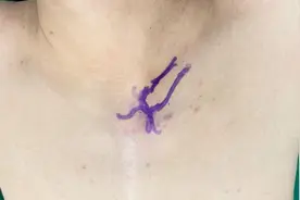 “小孔之光”指引胸外科完成院内第一例胸锁关节镜手术图片