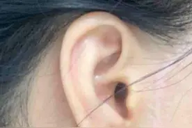 拉皮手术10年后面部状态怎么样？很多人都表示慌了，听医生解答图片