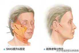 拉皮手术需要多长时间的恢复期？术后几天才能洗头？医生说细节图片