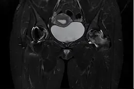 股骨头坏死疼痛后，为什么要拄拐？图片