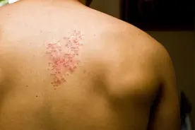 “蛇缠腰”让人痛不欲生！2个方法，教你如何应对，尽快康复图片