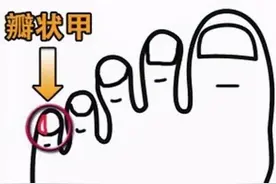 小脚趾指甲分两瓣是什么说法……图片