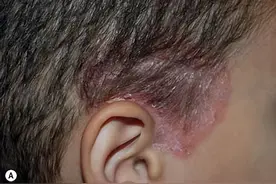 皮肤科专家教您如何对付头皮脂溢性皮炎图片